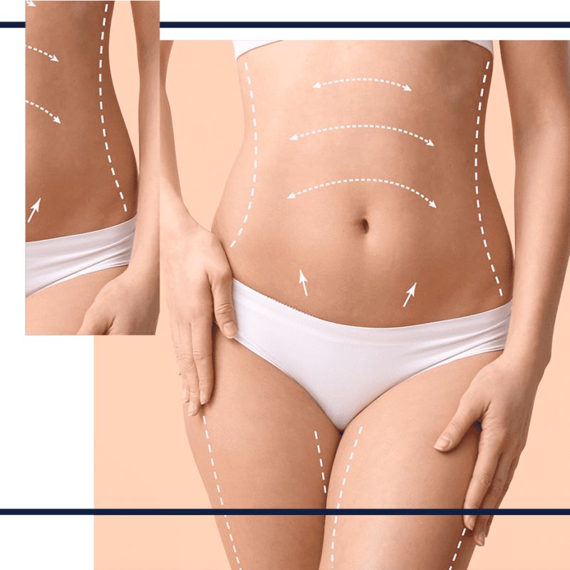 Vavi Clinics Izmir - Annelik estetigi mommy makeover