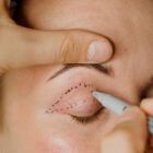 Vavi Clinics Izmir - Badem goz estetigi kantoplasti