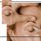 Vavi Clinics Izmir - Blefaroplasti goz kapagi estetigi